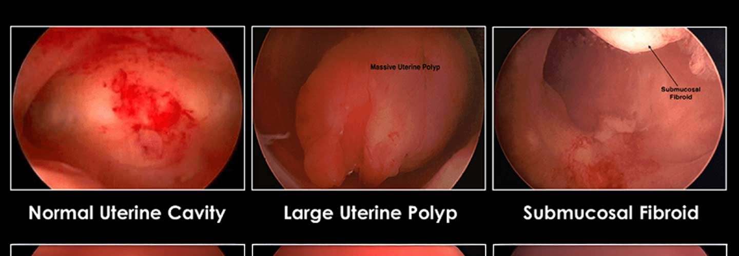 Hysteroscopy procedure image