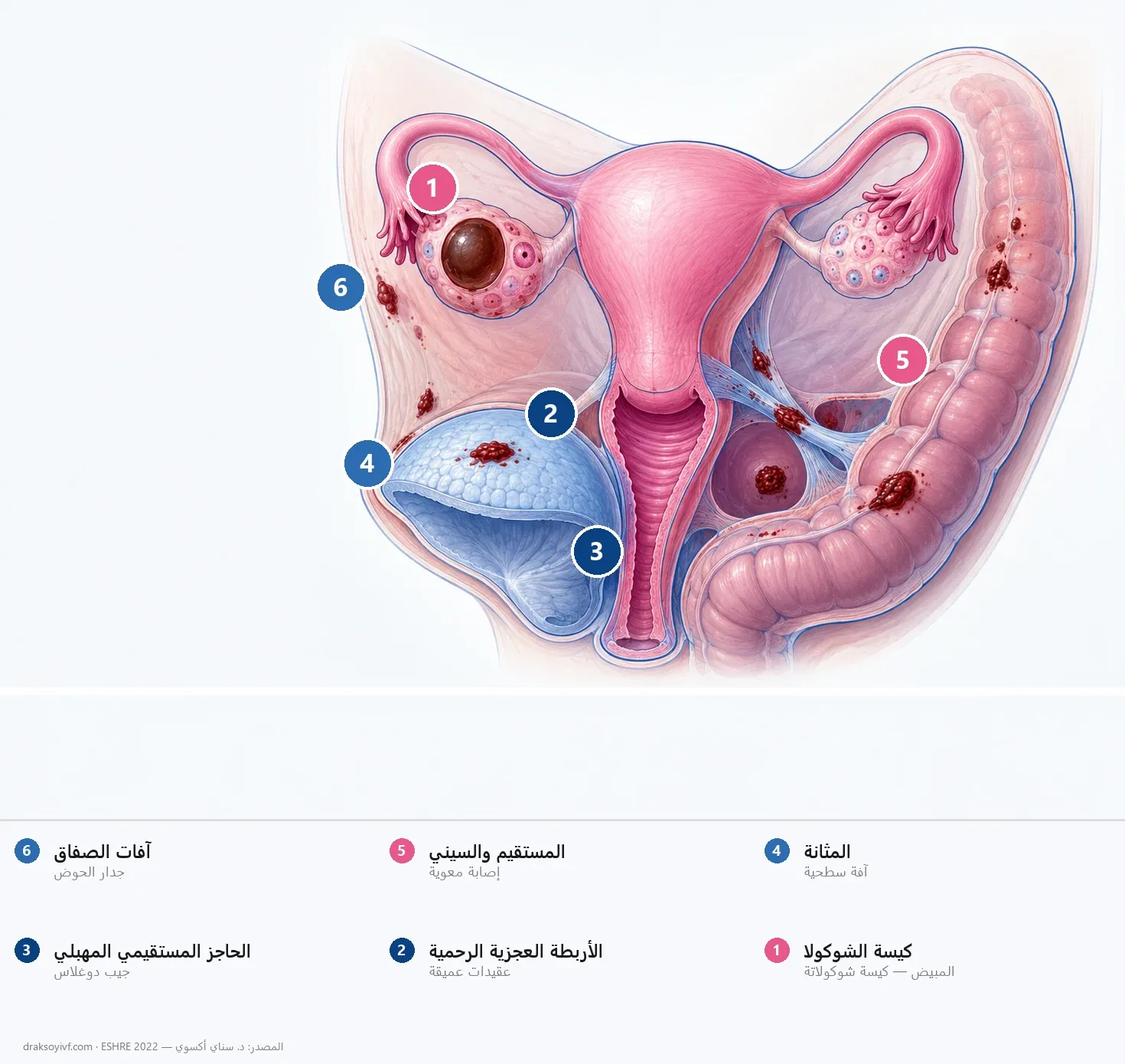 كيسة الشوكولا المبيضية: مراقبة أم جراحة، وأثرها على الخصوبة