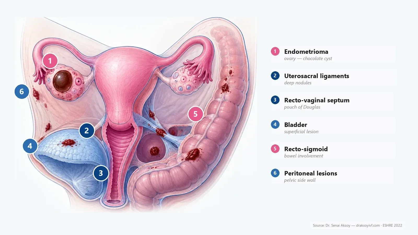 Ovarian endometrioma: surveillance or surgery, and impact on fertility