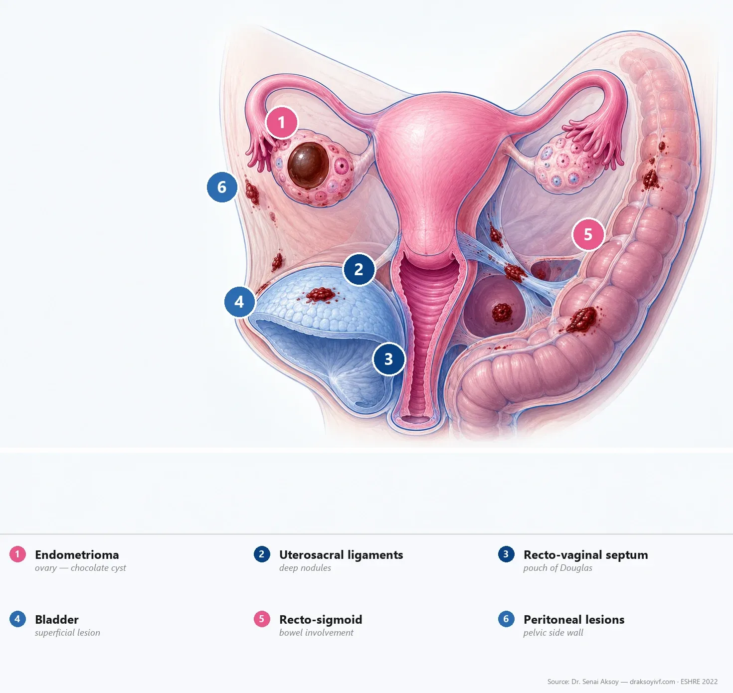 Diagnosing endometriosis: IDEA ultrasound, MRI and the new role of laparoscopy