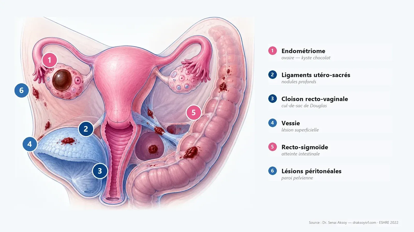 Endométriose : symptômes, diagnostic, traitement et fertilité