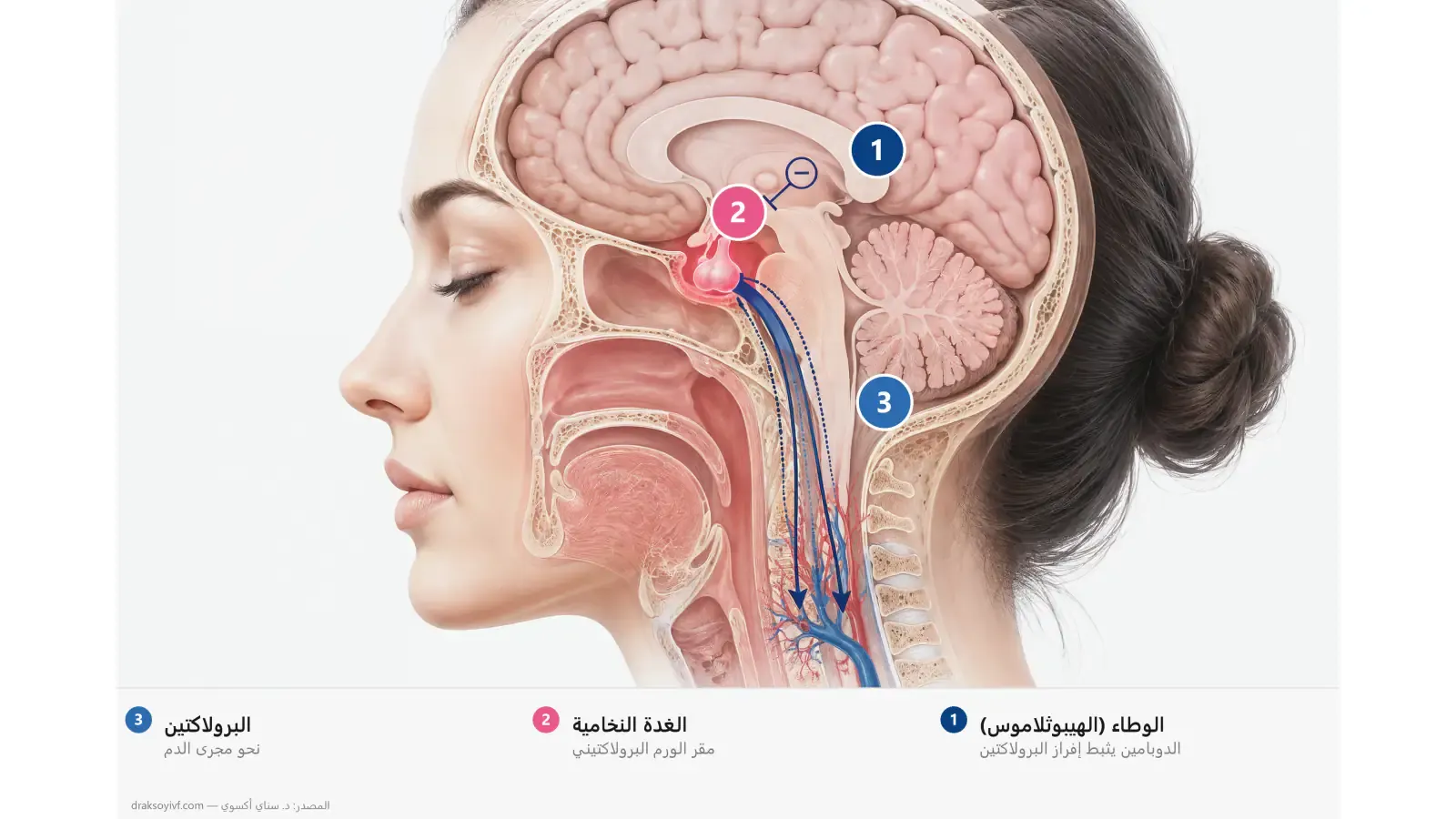ارتفاع البرولاكتين عند المرأة (فرط برولاكتين الدم)