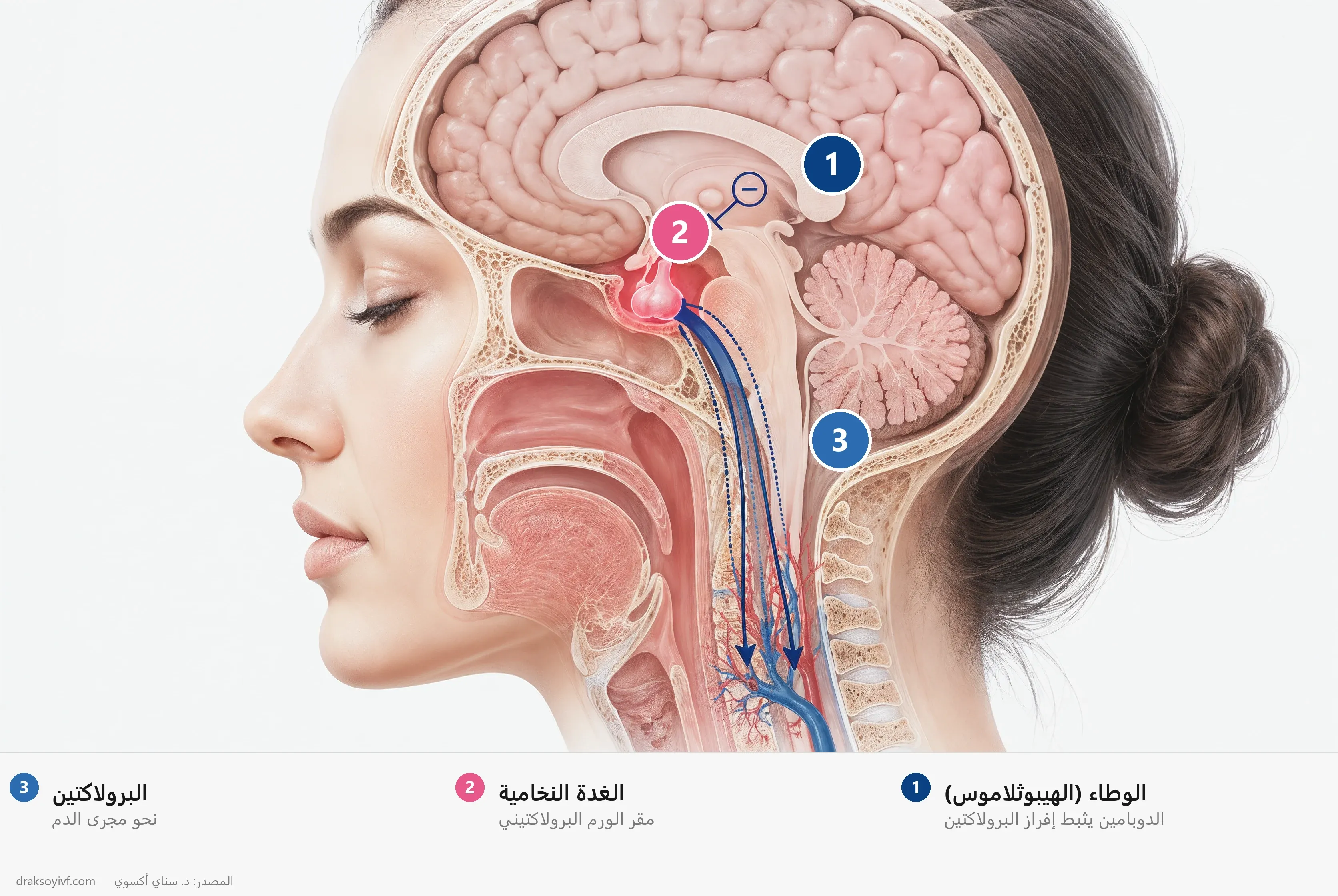فرط برولاكتين الدم: الأسباب والتشخيص والعلاج والخصوبة